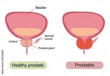 prostanu prostate health result illustration 3